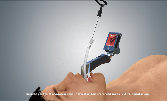 100mm chirurgischer Endoscopevideo Kehlkopfspiegel mit wiederverwendbaren Blättern